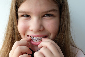 Girl removing her clear aligners, highlighting convenient orthodontic treatment for young patients. Clean closeup shot suited for dental education, aligner companies and pediatric dentistry promotions