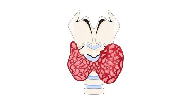 Enlarged thyroid gland affected by hyperthyroidism cartoon animation. Hormone imbalance. Overactive disorder in neck anatomy enlarging, growing animated flat 2D object 4K video isolated on white