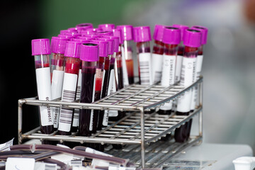 Close up of blood samples in test tubes with purple caps arranged in a metal rack at a laboratory. Medical analysis and health testing concept for diagnosis, research, and clinical examination.