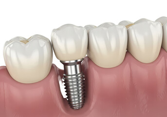 Dental implant restoration for healthy smile design