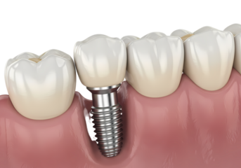Dental implant restoration for healthy smile design