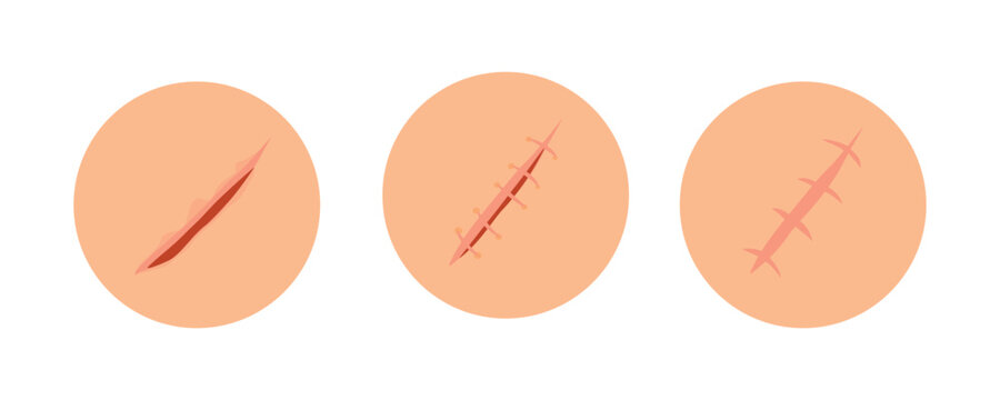 Set of healing wounds, skin scars, stitched gash and cuts