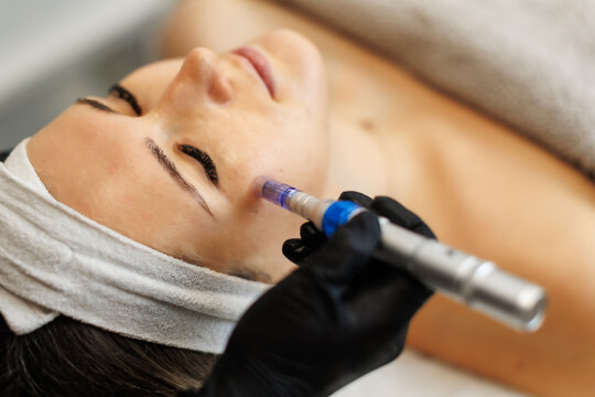 A close-up of a woman receiving microneedling therapy with a dermapen device on her cheek. The treatment is performed by a gloved professional in a serene spa setting