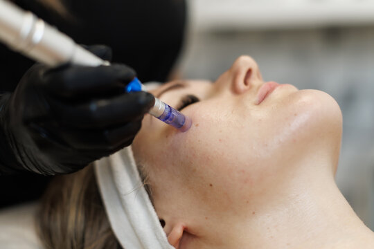 A close-up of a woman receiving microneedling therapy with a dermapen device on her cheek. The treatment is performed by a gloved professional in a serene spa setting
