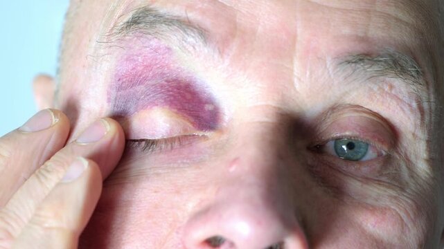 Eye senior man showing signs bruising, redness and hemorrhage. Medical condition, injury, hematoma, and healing process, blood vessel, violence and accident
