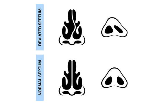 Deviated septum poster