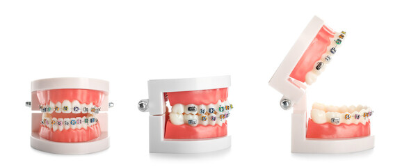 Collage of model of jaw with braces isolated on white