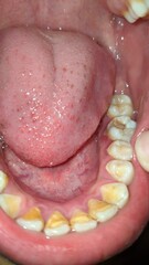Obraz premium Close-up view of an open human mouth showing lower teeth with yellow staining and a molar with a visible cavity or old filling, alongside the tongue.