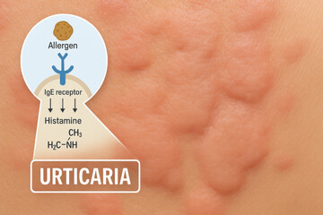 Urticaria rash on skin close up with clinical diagram of an allergic reaction. This medical education illustration shows an allergen, IgE receptor, and histamine chemical release