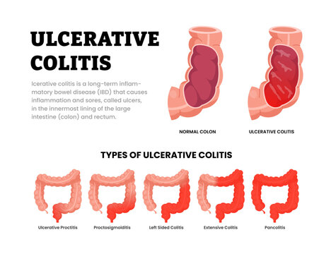 Different types of ulcerative colitis types. Labeled ulcerative proctitis, proctosigmoiditis, left sided colitis, extensive, pancolitis. Chronic inflammatory bowel disease. Lining colon and rectum.