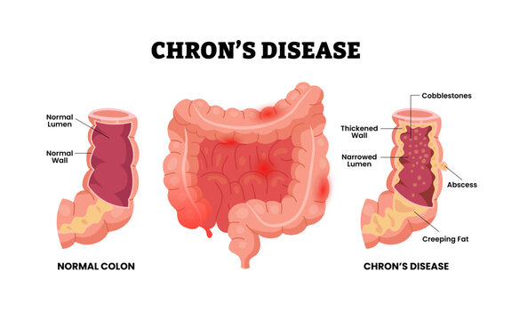 Crohn's disease with colon large intestine cross section view, thickened wall, narrowed lumen, abscess, creeping fat, cobblestones. Inflammatory bowel disease. Healthcare design poster illustration.