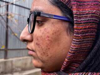 Detailed Close-Up of Facial Acne, Scars, and Hyperpigmentation. Inflamed Acne and Pigmentation Marks on woman face. Young girl facing skin problem as red bumps dark spots on her face