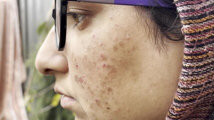 Detailed Close-Up of Facial Acne, Scars, and Hyperpigmentation. Inflamed Acne and Pigmentation Marks on woman face. Young girl facing skin problem as red bumps dark spots on her face