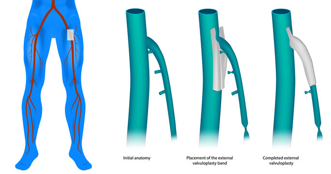 Medical illustration showing the steps of external valvuloplasty applied to the great saphenous vein at the saphenofemoral junction. Junction Repair with External Banding