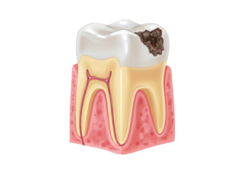 Isolated Cartoon illustration of a tooth with cavity and root canal disease, dental hygiene
