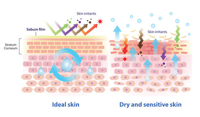 Comparison of ideal, dry and sensitive skin illustration. Intercellular lipids hold water and link the cells together, the sebum protect skin from irritants. When sebum decreased, the skin damaged.