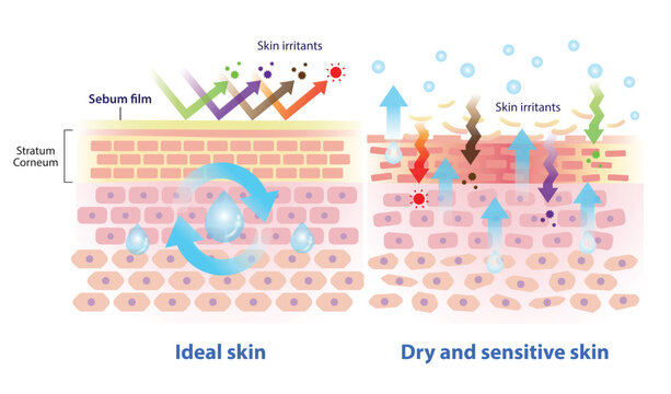 Comparison of ideal, dry and sensitive skin illustration. Intercellular lipids hold water and link the cells together, the sebum protect skin from irritants. When sebum decreased, the skin damaged.