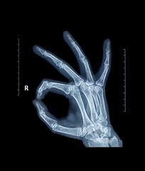 X-ray hand bones OK ring gesture joining the thumb and index finger in a circle