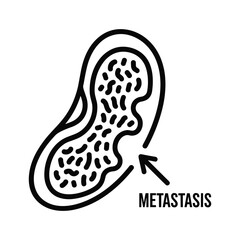 Metastasis in kidney isolated on, a secondary cancerous growth from a primary tumor site