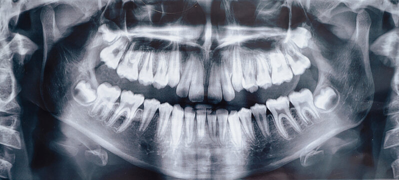 Panoramic dental X-ray image of a child&rsquo;s jaw