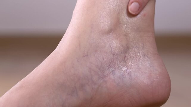Close-up view of visible leg veins and mild telangiectasia on adult skin, highlighting subtle vascular patterns and early signs of venous insufficiency. Medical, dermatology, healthcare-focused video.