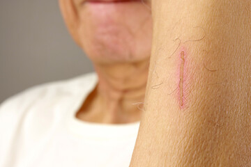 Naklejka premium Man with a scab on his arm caused by a scratch that’s healing
