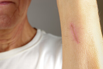 Fototapeta premium Man with a scab on his arm caused by a scratch that’s healing