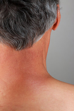 Man with slight sunburn on the back of his neck