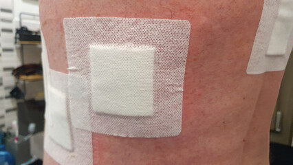 Postoperative Back With Dressings, Scars and Stitches