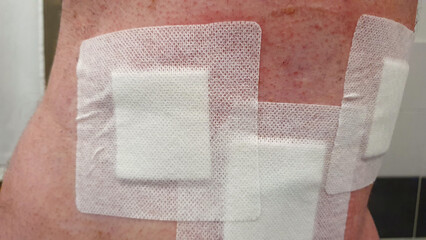 Postoperative Back With Dressings, Scars and Stitches