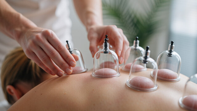 close up of transparent cupping therapy cups applied to a person&rsquo;s back during a wellness treatment in a calm therapeutic setting
