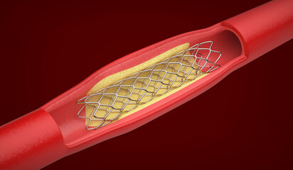 Medical stent inside blood vessel to improve blood flow