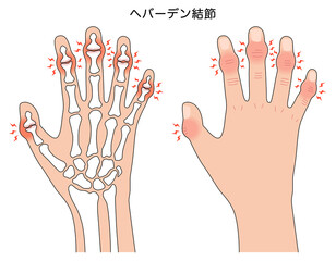 へバーデン結節　指の関節の病気