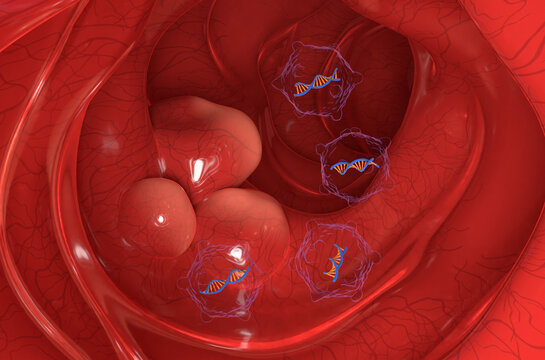 Gene therapy in Colon, Colorectal cancer (CRC) - section view 3d illustration