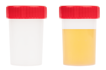 Empty urine sample container and urine test tube isolated on white background