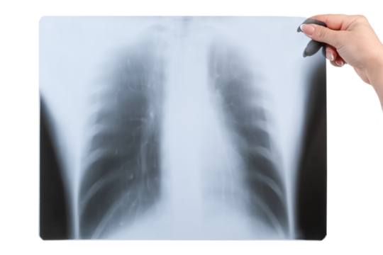 in a female hand x-ray of the lungs isolated on a white background