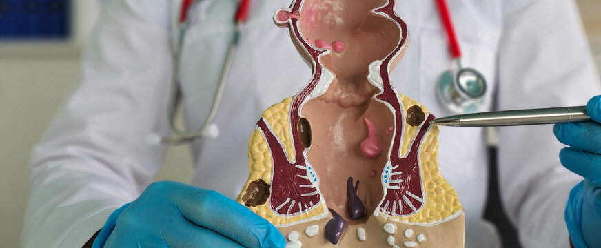 A doctor explains the anatomy of the rectum and anus using a model concept