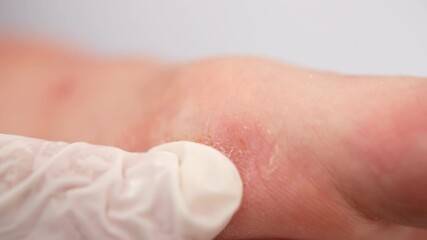 Chronic stress or allergy reaction on additional chemicals of today's society leading to serious dermatological diseases like dyshidrotic eczema, atopic eczema, psoriasis or dermatitis, acute symptoms