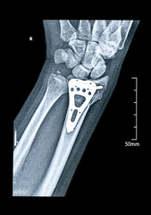 X-ray of hand surgical options for treating a distal radius fracture Inserting a purpose-built orthopaedic plate with open reduction internal fixation