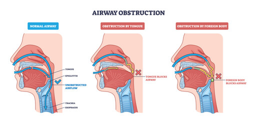 Airway obstruction diagram shows normal airflow vs blockage by tongue or foreign body, key parts, tongue, epiglottis, trachea. Outline diagram © VectorMine