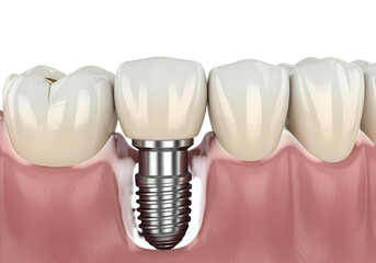 Dental implant replacing missing tooth professionally
