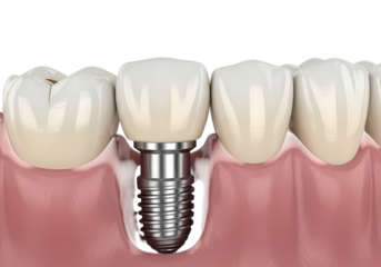 Dental implant replacing missing tooth professionally