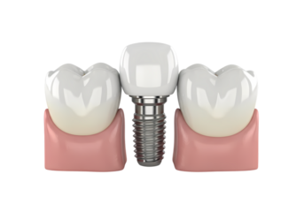 Dental implant offers brighter smile and oral health