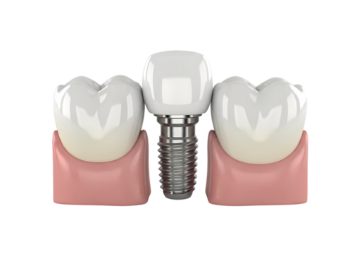 Dental implant offers brighter smile and oral health