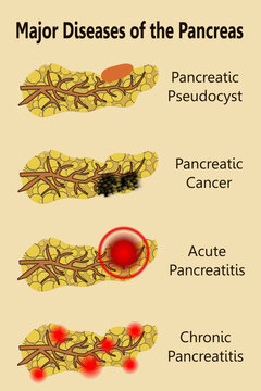 Major Diseases of the Pancreas, early signs of pancreatic cancer