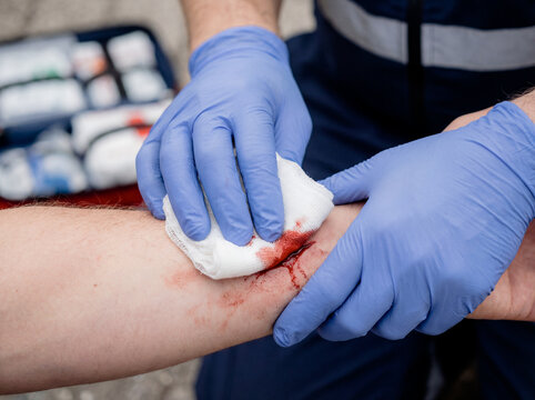 Medic hands in blue gloves cleaning bleeding wound with gauze pad first aid emergency care medical treatment injury disinfection healthcare antiseptic assistance trauma blood sterile procedure closeup