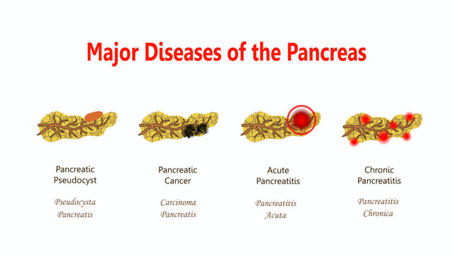 Major Diseases of the Pancreas, diagram with Latin names