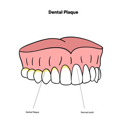 Hand-drawn dental infographic illustrating the formation of dental plaque on tooth anatomy. Includes enamel, dentin, pulp, gum line, and bacterial buildup area