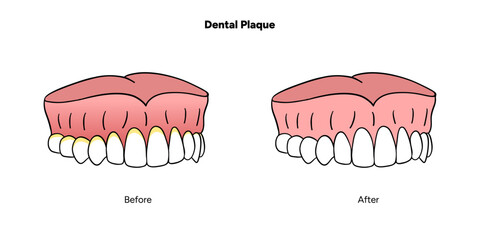 Hand-drawn dental infographic illustrating the formation of dental plaque on tooth anatomy. Includes enamel, dentin, pulp, gum line, and bacterial buildup area