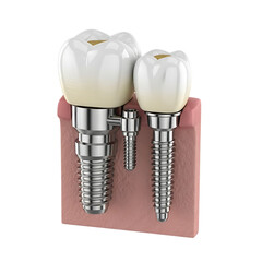 Dental Implants With Crowns And Abutments In Gum Section On Black Background teeth